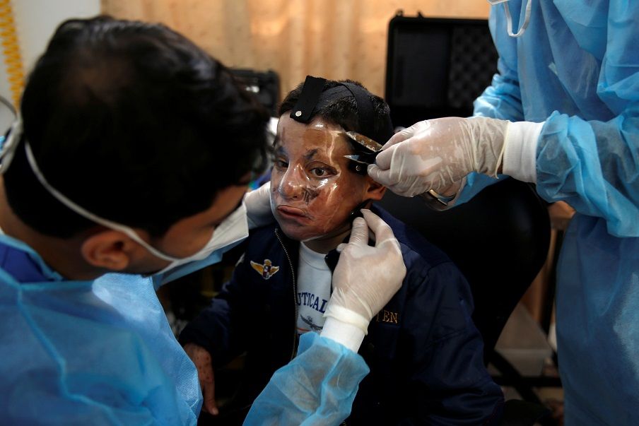 منظمة أطباء بلا حدود تغير حياة ضحايا الحروق في غزة
